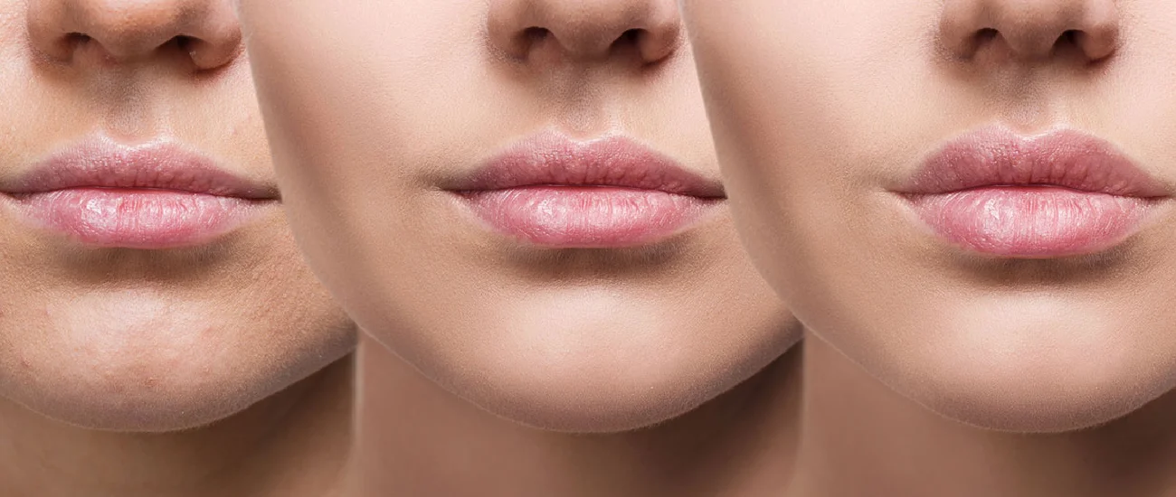 Lip Filler Touch-Ups