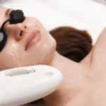IPL Photofacial