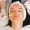 chemical peel