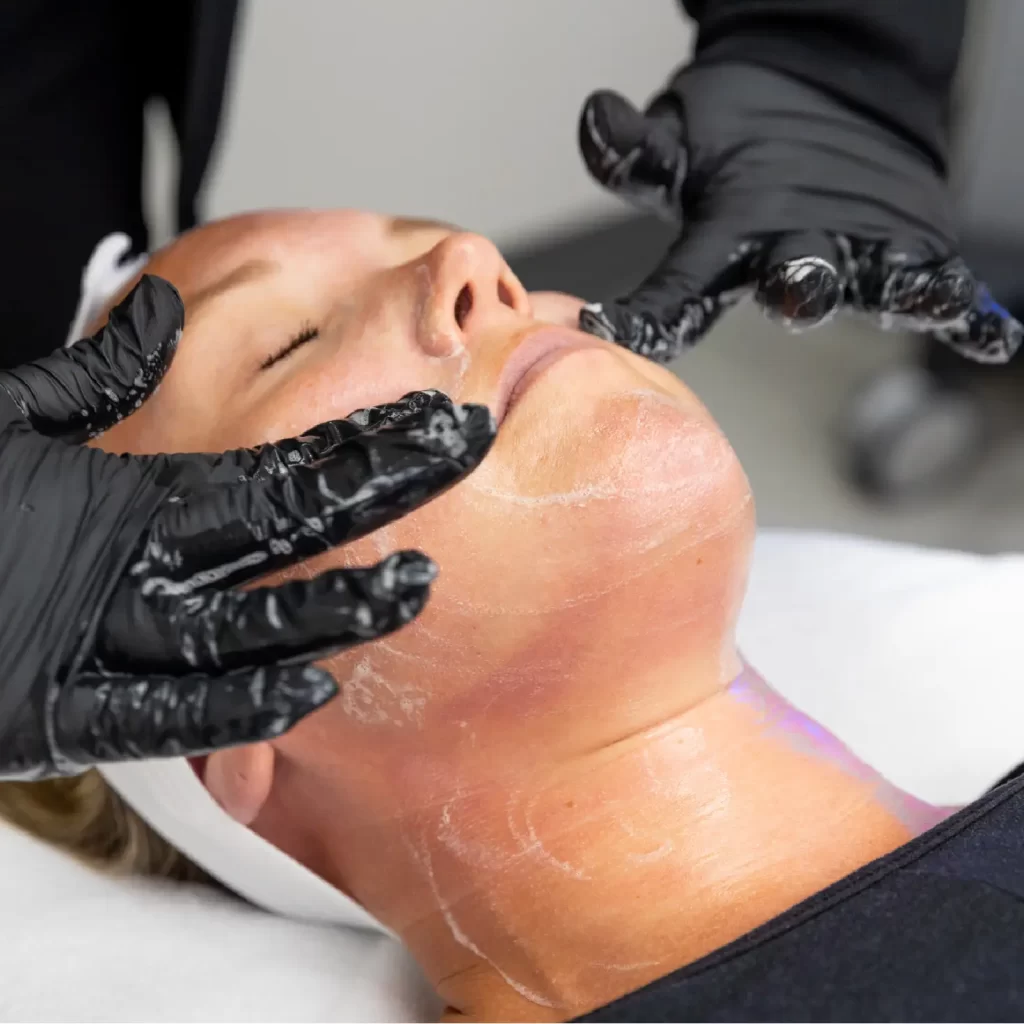 chemical peel
