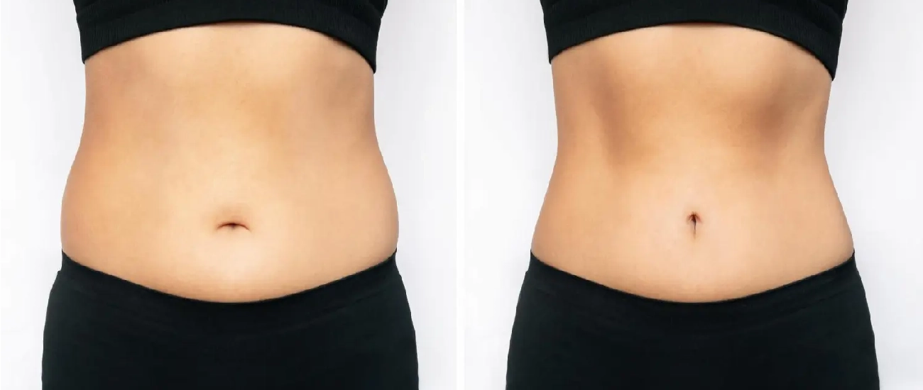 CoolSculpting Vs Liposuction: Key Differences